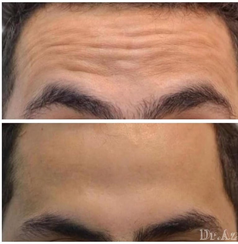 بوتوكس