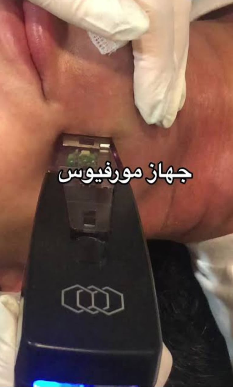 مورفيوس- مسامات متوسعة , ندبات حب الشباب