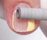 Gel removal