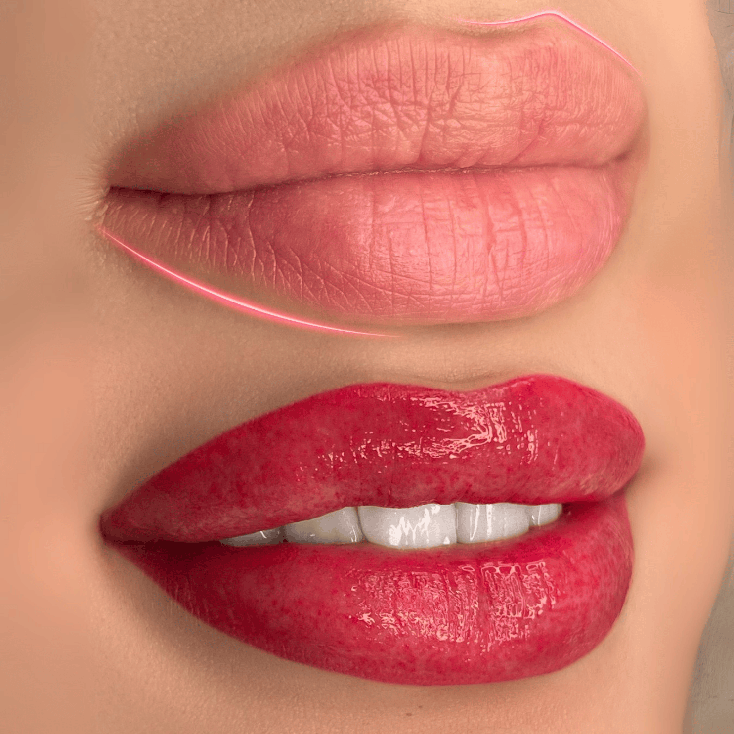 توريد الشفاه