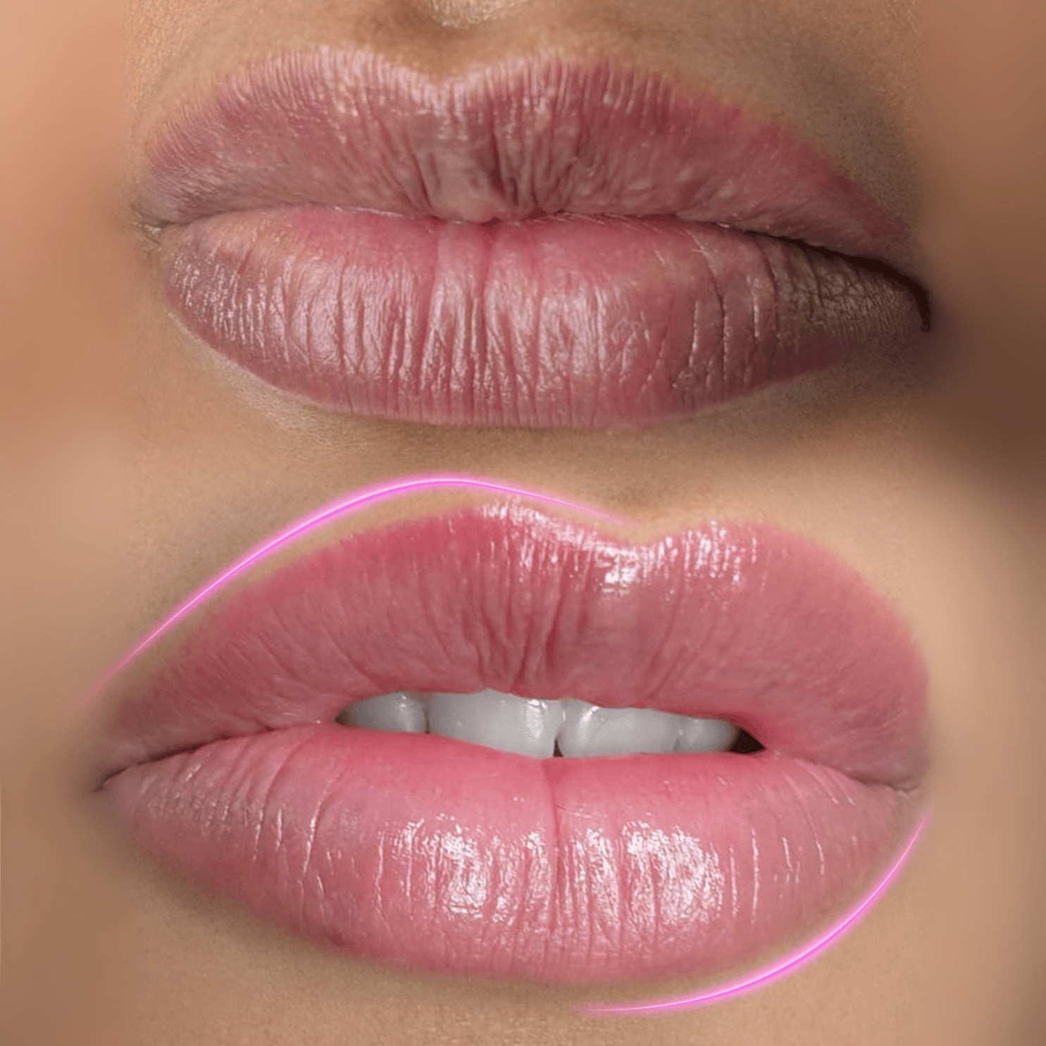 توريد الشفاه